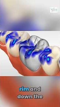 Secret to Better CEREC Occlusion | Posterior Workflow Part 2