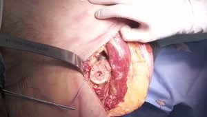 Conversion THA: Intramedullary nail extraction and THA via Direct Anterior approach