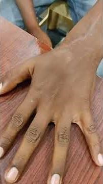 Extensor Pollicis Longus (EPL) Tendon Repair ..Dr Sai Chandra MBBS DNB (Ortho)