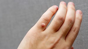 Common Warts On Fingers: Are They Contagious?
