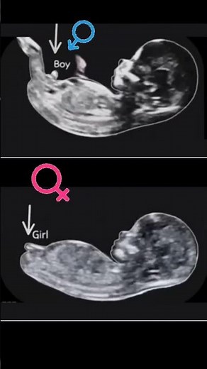 BOY \\ GIRL ,12 Week's nub Theory Gender Reveal ultrasound scan#baby #ultrasound #shorts