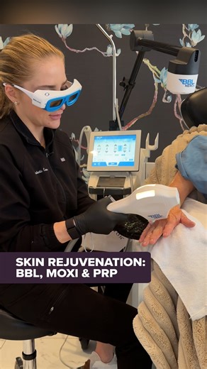 Treating our patient with the ultimate skin rejuvenation combo: BBL (Broadband Light) and Moxi laser �