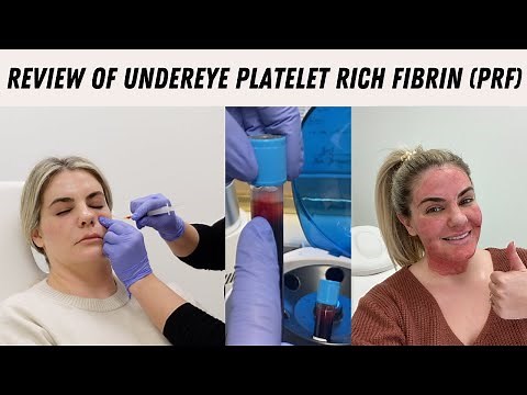 Undereye Platelet Rich Fibrin (PRF) Review
