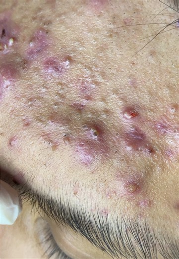 Nhẹ nhàng tình cảm #SắcĐẹpSpa #trịmụnuytín #SpaChuyenMun #trimungovap #nặnmụnbằngtay