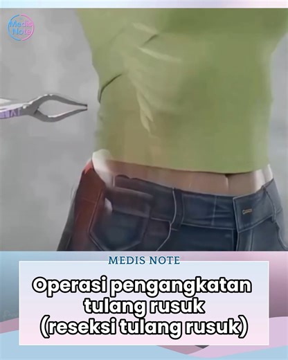 MEDIS NOTE on Instagram: "Operasi pengangkatan tulang rusuk, atau rib resection, adalah prosedur bedah untuk membuang sebagian tulang rusuk guna menangani kondisi medis tertentu, seperti thoracic outlet syndrome (TOS), atau untuk membantu dokter mendapatkan akses yang lebih jelas saat melakukan operasi di area dada. Pada prosedur reseksi tulang rusuk pertama, fokus pembedahan berada pada tulang rusuk yang terletak tepat di bawah tulang selangka. Tindakan ini bertujuan mengurangi tekanan pada sar