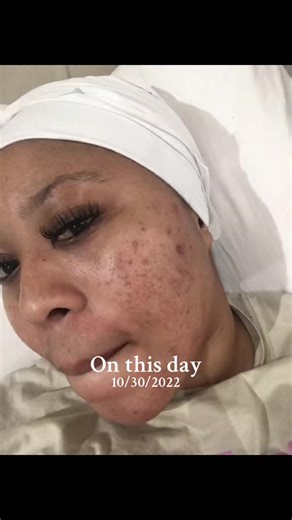 Dealing with Acne Scars: My Skin Bleaching Journey