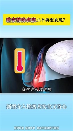 精索静脉曲张三个典型表现？新型介入栓塞术安全又省心#精索静脉曲张 #介入 #手术