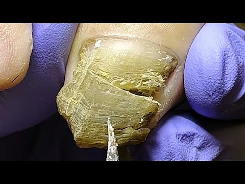 Fingernails cut open and found to be full of dirt.