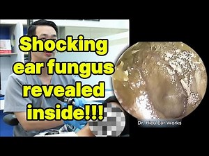 Shocking ear fungus revealed inside | ear cleaning | ASMR earwax | soothing |relax|