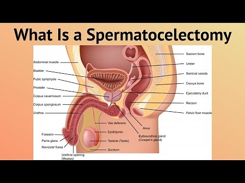 What Is a Spermatocelectomy