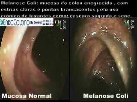 Melanose Coli