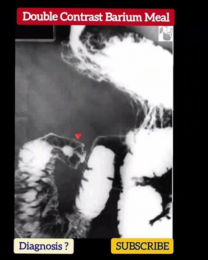 Diagnosis ? Upper GI series - Double Contrast Barium Meal - Practical Case - Radiology