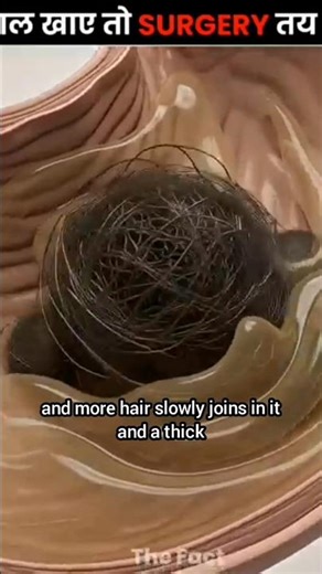 Eating Hair Can Be Deadly 💀#shorts #ytshorts #trending