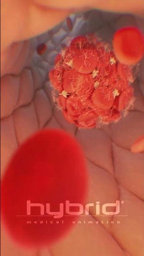 Venous thromboembolism | Deep vein thrombosis (DVT) | #thrombosis #medicalanimation #bloodclot