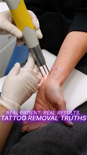 Orentreich Medical Group on Instagram: "🎥 REAL PATIENT. REAL RESULTS. 💯✨ Tattoo removal isn’t a one-and-done… it’s a PROCESS...and today our patient is sharing what it’s really like while we treat their tattoo with the Q-Switched Ruby laser (694 nm).⚡️ 💬 We cover the honest details: ✅ how many treatments it really takes 😬 if it actually hurts ⏳ what the process is like from start to finish And yes...we’re treating with the Q-Switched Ruby laser (694 nm) 🎯✨ (a go-to for targeting tattoo pigm