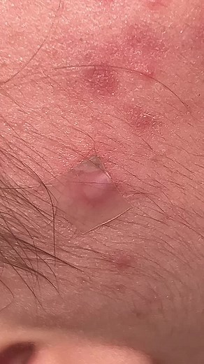 Pimple Patch and Hydrocolloid Patches Removal Videos