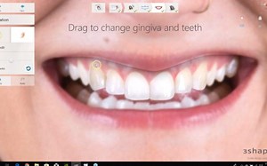 3shape前牙美学设计DSD教程