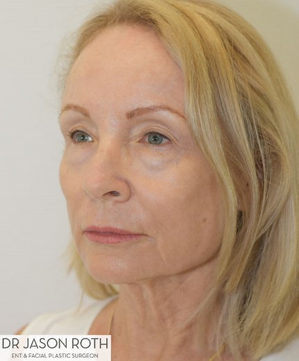 Deep Plane Facelift Surgeon Sydney | Dr Jason Roth FRACS
