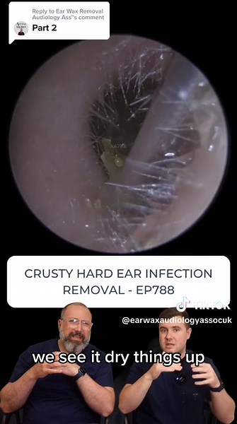 Crusty Hard Ear Infection Removal Explained - Part 2