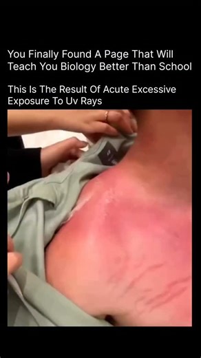 BIOLOGY | MEDICAL | HEALTH on Instagram: "This is the result of acute excessive exposure to UV rays — a sudden overload of harsh sunlight that damages your skin cells faster than your body can repair them. 🔥☀️ It leads to redness, burning, peeling, inflammation, and sometimes even fluid-filled blisters. UV rays penetrate deep into the skin, breaking down collagen, accelerating aging, and increasing the risk of long-term skin problems. Always protect your skin — sunscreen is not optional, it’s e