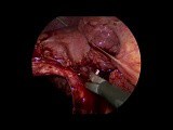 Laparoscopic Cholecystectomy for Acute Calculous Cholecystitis with Cirrhotic Liver and Portal Hypertension s/p Percutaneous Cholecystostomy • Video • MEDtube.net
