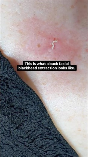 Back facial extractions. Stop stripping your skin. This is why. #BioBarrierMethod 👇