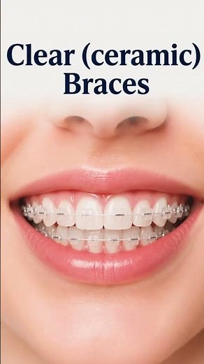 6 Types of Braces Explained | Which Braces Are Best for You? | Dr. Gaurav Gupta