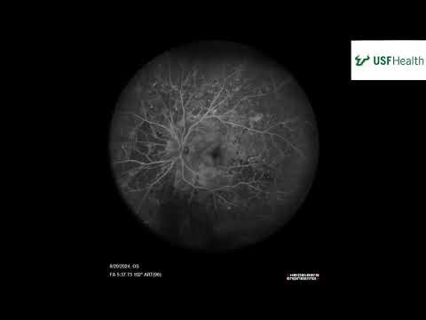 NPDR with capillary non-perfusion - Arianna Norman, DO - 2025 11 14 - USF Ophthalmology