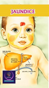 4.6K views · 34 reactions | How Jaundice Happened in Children's #fbreel #foryou #medical #animation | Medical Animation Media | Facebook