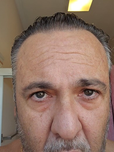 Exame Lipoproteína A: Previne Infarto e Derrame