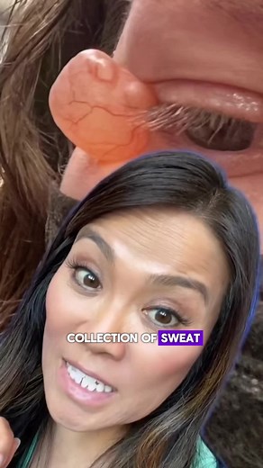 Sandra Lee, MD, FAAD, FAACS on Instagram: "This was the biggest hidrocystoma I've ever seen!⁠ ⁠ 💧 These harmless cysts form when sweat glands get a little clogged, creating a tiny bubble under the skin. They’re not pimples, and they’re treatable in a variety of ways - simple excision, cauterization or with CO2 lasers. Botox can even help ✌️❤️💥⁠ ⁠ #drpimplepopper #popaholics #dermatology #hidrocystoma #medicaleducation"