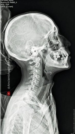 X-Ray Reveals the Secrets of Amenhotep II’s Mummy