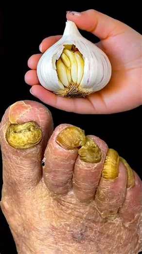 Remove foot fungus with garlic forever!
