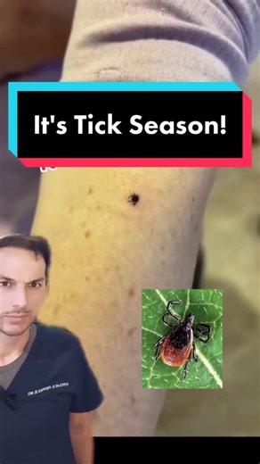 What's the best way to remove a tick? #tick #lymedisease #tweezers #fyp