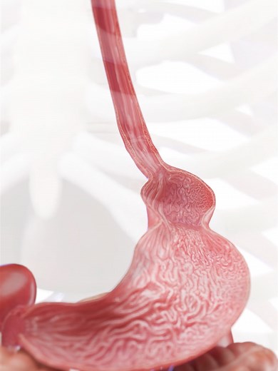 Hiatal Hernia: Stomach Pushing Through Diaphragm