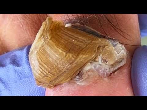 Curled Toenails Look Like A Bridge! Perfect Trimming【Xue Yidao】