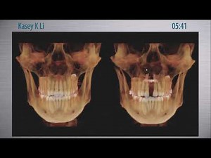 World Sleep 2002/Maxillary Expansion: Surgical consideration