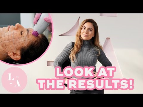 Uldouz | Thermage Experience
