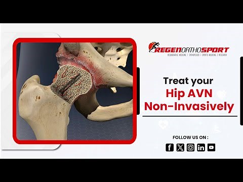 Avascular Necrosis, a Disease That Kills the Bone Tissue in the Hip Joint | RegenOrthoSport