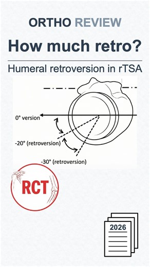 Ortho Review | Shoulder & Elbow on Instagram: "0° vs 30° humeral retroversion in rTSA — does version actually change rotation and outcomes? Ventura-Parellada, et al. Humeral component retroversion in the Comprehensive Reverse Shoulder System arthroplasty: rotations, clinical outcomes, and quality-of-life analysis in a prospective randomized study. J Shoulder Elbow Surg. 2026;35(1):2-10. #orthopedics #orthosurgery #shouldersurgery #meded #surgery"
