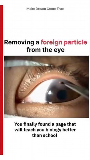 👁️ Removing a ⚠️ foreign particle from the eye 🧿 | MDCT