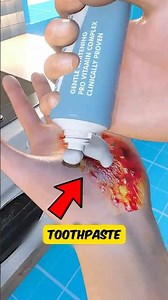 Don’t Do This When You Burn Yourself