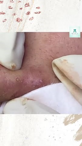 Big Cystic Acne Blackheads Extraction Blackheads & Milia, Whiteheads Removal Pimple Popping #shorts