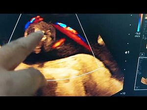 Nuchal cord around the fetal neck in ultrasound views.