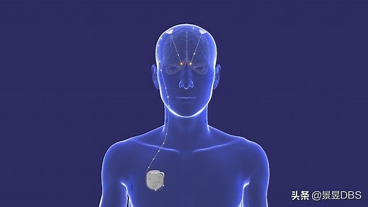 脑深部刺激（DBS）手术动画演示