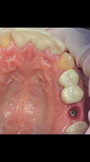 Dental Implant Procedure: Tooth Replacement Explained