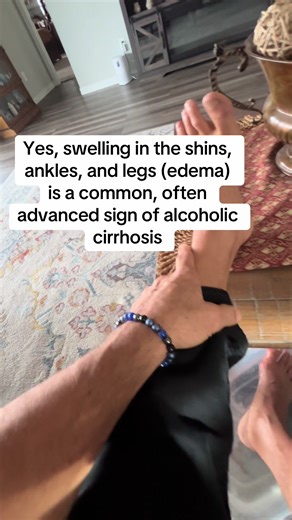 Signs of alcohol cirrhosis in your 30s and 40s | cirrhosis