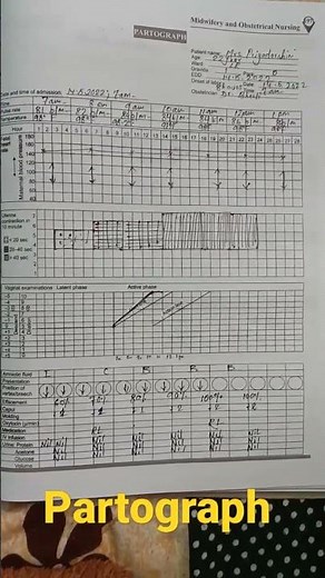 Normal delivery with partogram #partogram #labour #shorts