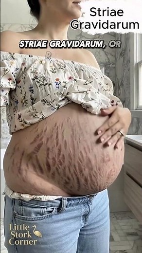 Why Do Pregnancy Stretch Marks Actually Happen? 🤰