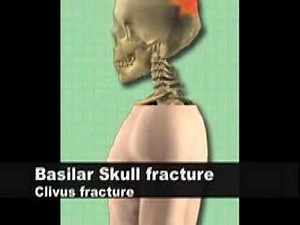 anatomy & physiology of skull fractures